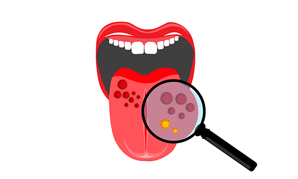 hpv-positive oropharyngeal cancer